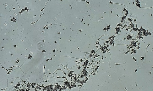 You are currently viewing Positive Antisperm Antibody Test