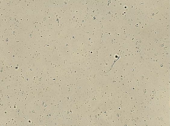 Microscopic view of a semen sample showing rare non-motile sperm following vasectomy.