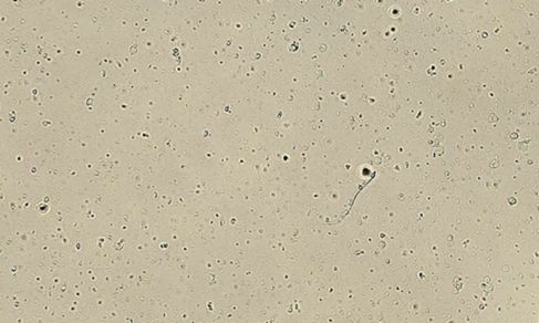 You are currently viewing Post Vasectomy – Rare Non-Motile Sperm